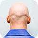 Male Hair Loss